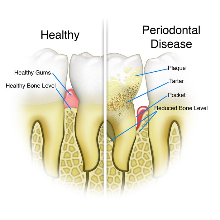 Gum (Periodontal) Treatments